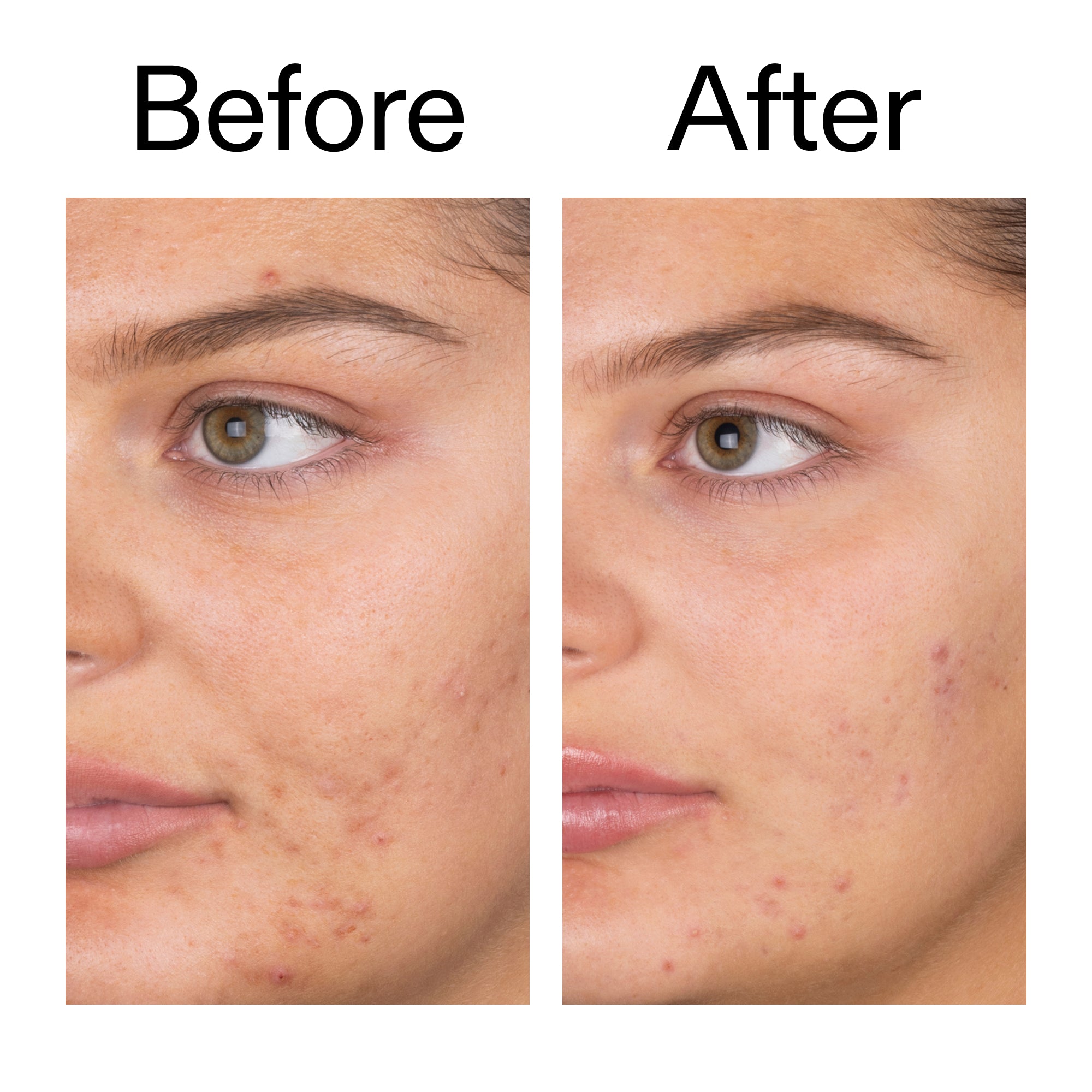 Salicylic Acid Cleanser - 150ml