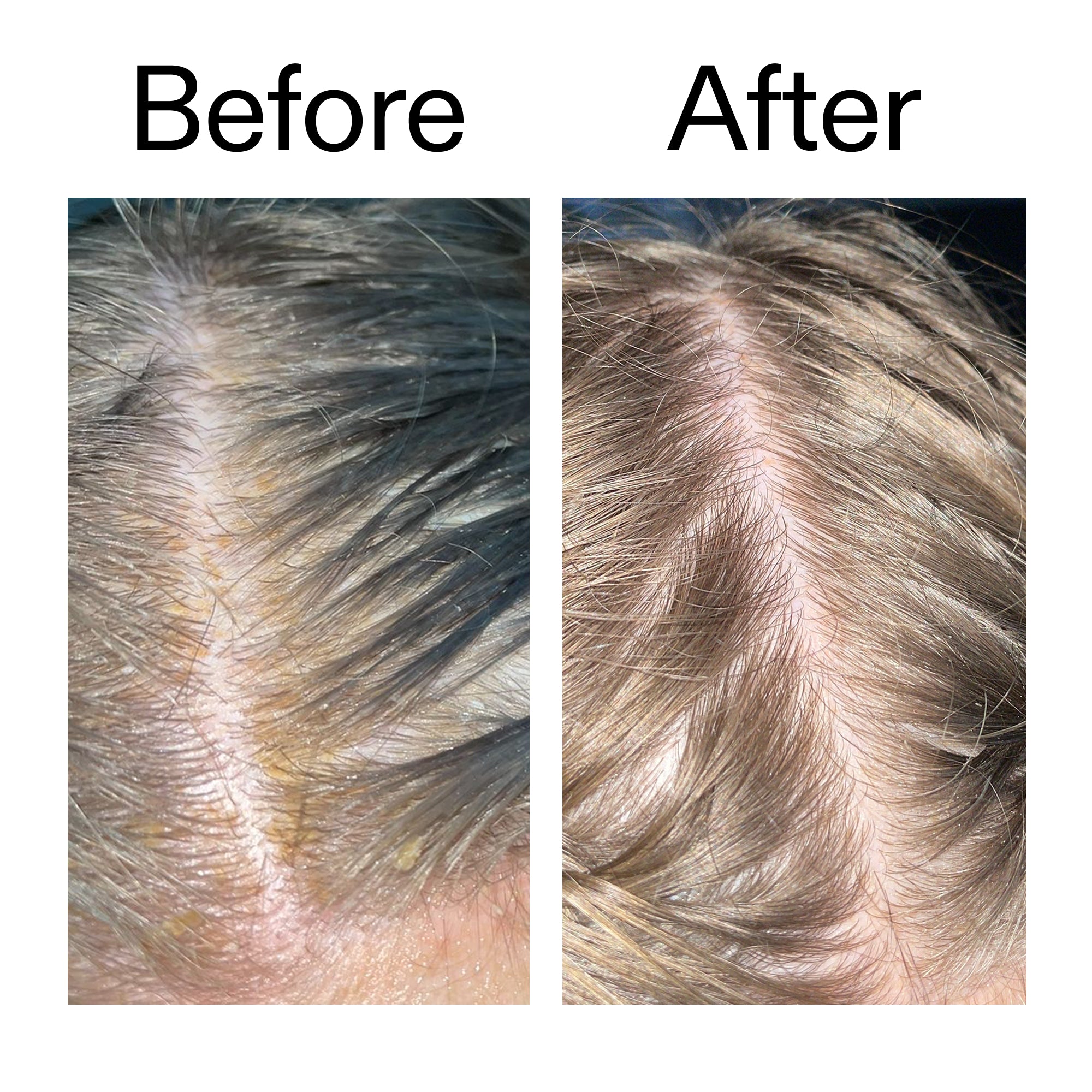 Salicylic Acid Exfoliating Scalp Treatment