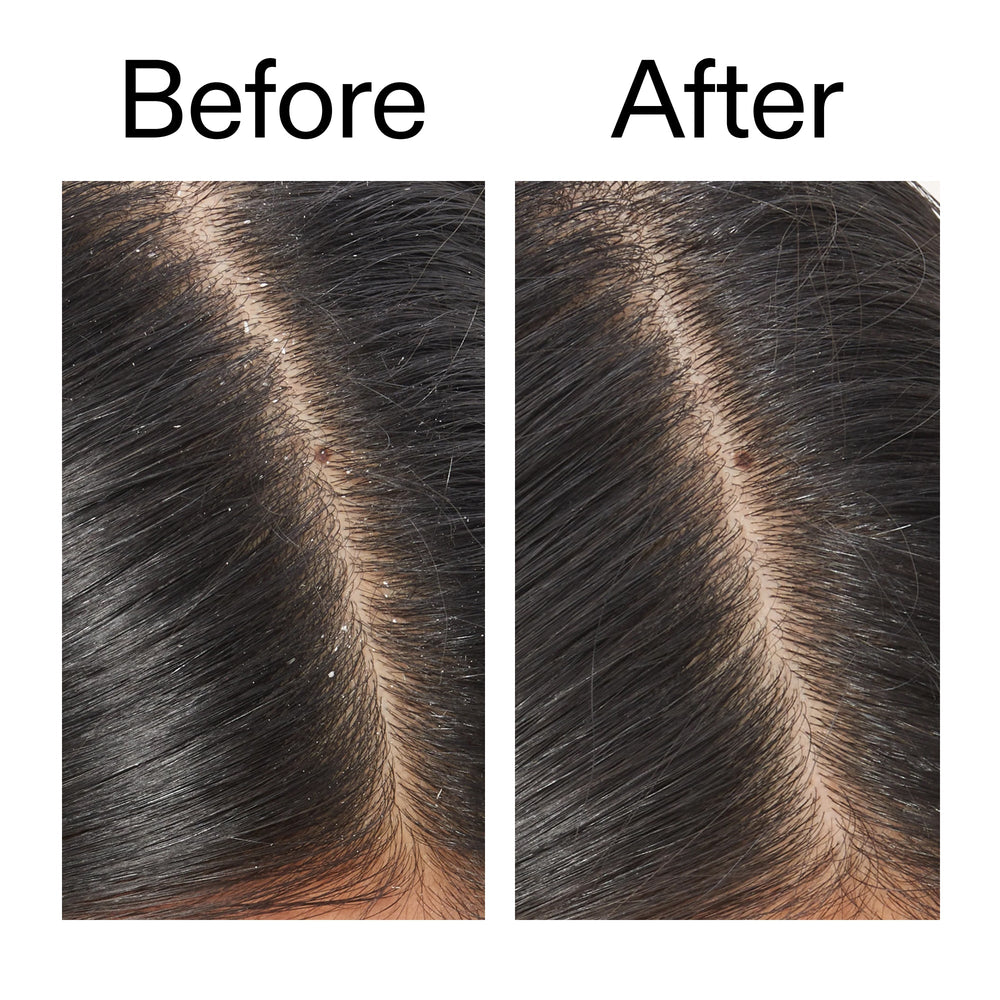 Salicylic Acid Exfoliating Scalp Treatment